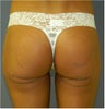 33 year old with flat sagging buttocks would like a natural lift using her own fat