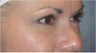 Restylane