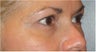 Restylane