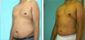 Liposuction Before & After
