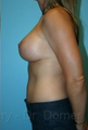 Breast Lift