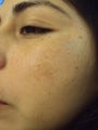 Chemical Peels