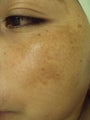 Chemical Peels