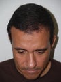 Hair Transplant - 3400 grafts