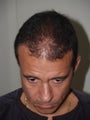 Hair Transplant - 3400 grafts