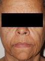 Female Patient Treated with Radiesse
