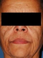 Female Patient Treated with Radiesse