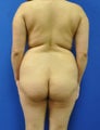 Brazilian Butt Lift