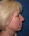 Neck Lift