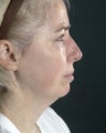Neck Lift