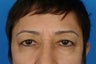 65F who wanted an eyelift to look "less angry".