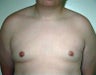 Adolescent Male treated for Breast Reduction