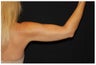 CoolSculpting