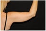 CoolSculpting