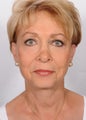 Facelift, upper and lower eyelid lift
