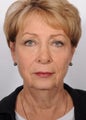Facelift, upper and lower eyelid lift