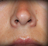 Rhinoplasty