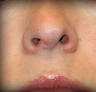 Rhinoplasty