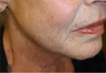 Ultherapy Neck