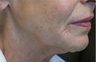 Ultherapy Neck