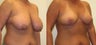 Breast Reduction, Breast Lift