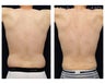 Liposuction