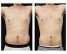 Liposuction