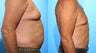 72 Year Old Man Chest , Abdominal , and Love Handle Liposculpture