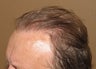 Neograft FUE hair transplantation
