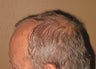 Neograft FUE hair transplantation