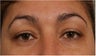 44 Year olf female with sagging of her eye brows and upper eye lids. She doesn't want surgery