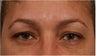 44 Year olf female with sagging of her eye brows and upper eye lids. She doesn't want surgery