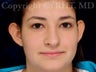 19 yo woman; local anesthesia otoplasty for protruding ears