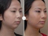 Chin Implant Surgery for definition, 30 Year Old Female