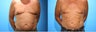 72 Year Old Man Chest Abdominal Chest, Love Handles , Abdominal Liposculpture