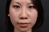 This young lady underwent alar base (nostril) reduction under local anesthesia