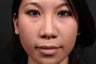 This young lady underwent alar base (nostril) reduction under local anesthesia