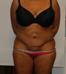 Large Abdominoplasty 3 months before and after
