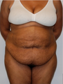 Large Abdominoplasty 3 months before and after