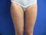 46 Year Old Female Treated for Saddle Bag Fat Deposits