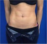 Laser Liposuction