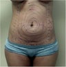 Laser Liposuction