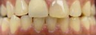 Spacing Corrected with Invisalign