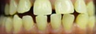 Spacing Corrected with Invisalign