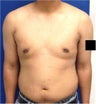 Laser Liposuction
