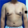 Laser Liposuction