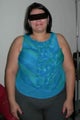 34 year old woman treated for severe obesity
