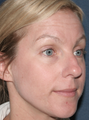 Fraxel Laser for Hyperpigmentation