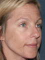 Fraxel Laser for Hyperpigmentation