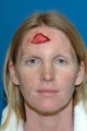 Forhead reconstruction after Mohs surgery
